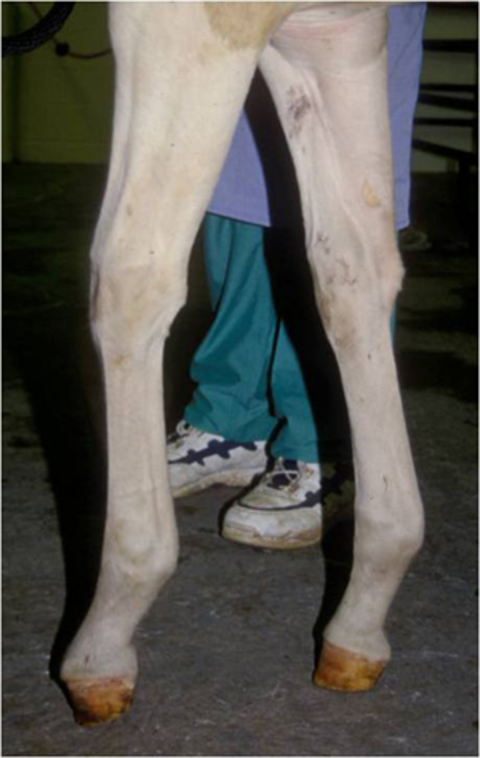 Club foot, stage II deformity