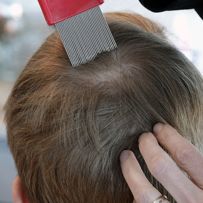 Combing hair with a nit comb to remove lice eggs from scalp and hair.
